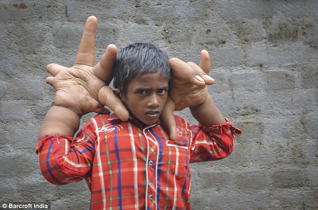 يدا طفل هندي أكبر من رأسه 