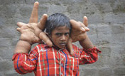 يدا طفل هندي أكبر من رأسه 