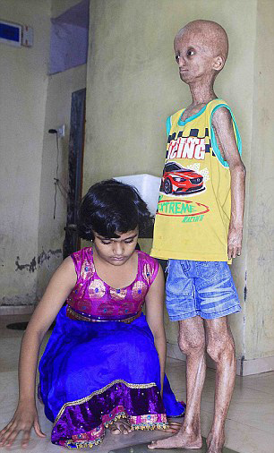 مرض غريب يتسبب في سقوط وزن شاب هندي إلى 12 كلغ
