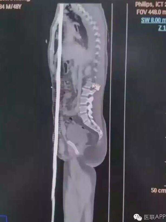 معجزة طبية: رجل مثقوب بحديد تسليح بطول 1.5 متر ينجو من الموت