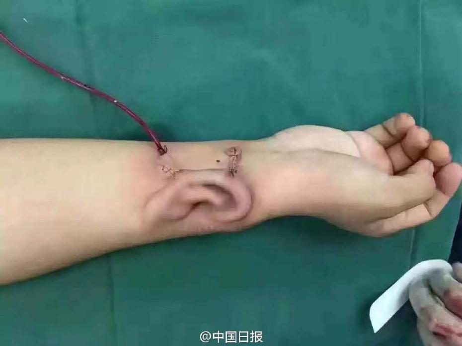 طبيب صيني يعيد بناء أذن جديدة مع الضلع