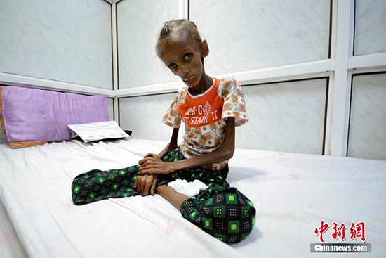 اليونيسيف : نحو 2.2 مليون طفل في اليمن يعانون من سوء التغذية