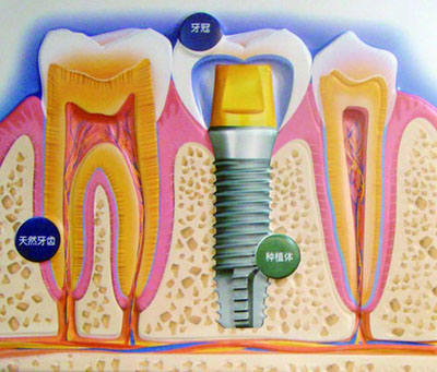 بدء التجارب السريرية على الأسنان المطبوعة بالطباعة ثلاثية الأبعاد في الصين