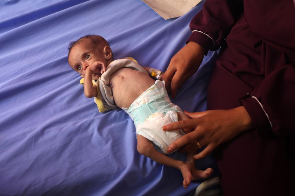 الصورة: معاناة أطفال غزة بسبب الجوع